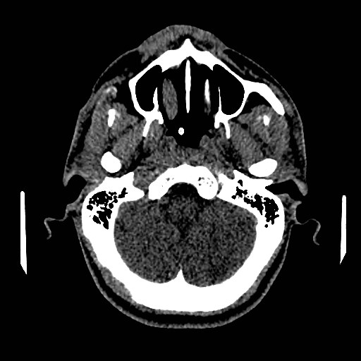 File:Acute basilar artery occlusion (Radiopaedia 43582-46985 Axial non-contrast 41).jpg