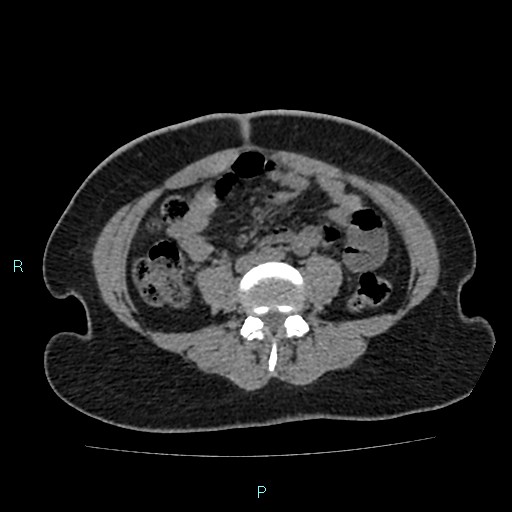 Acute bilateral pyelonephritis (Radiopaedia 37146-38881 Axial non-contrast 65).jpg