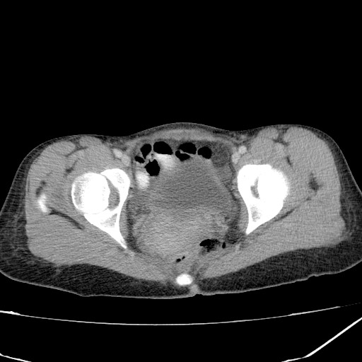 Acute bilateral pyelonephritis (Radiopaedia 74153-84969 Axial C+ portal venous phase 47).jpg