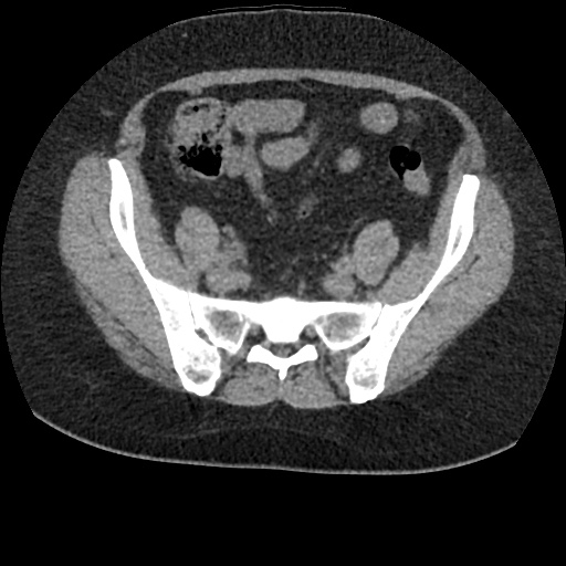 Acute cholecystitis and ureteric colic (Radiopaedia 42330-45444 Axial prone 80).jpg
