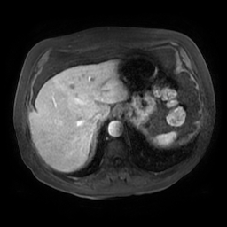 Acute cholecystitis complicated by pylephlebitis (Radiopaedia 65782-74915 Axial arterioportal phase T1 C+ fat sat 23).jpg