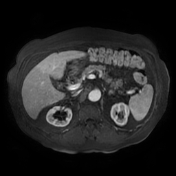 Acute cholecystitis complicated by pylephlebitis (Radiopaedia 65782-74915 Axial arterioportal phase T1 C+ fat sat 61).jpg