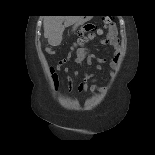 Acute cholecystitis with tensile fundus sign (Radiopaedia 71394-81723 Coronal non-contrast 40).jpg