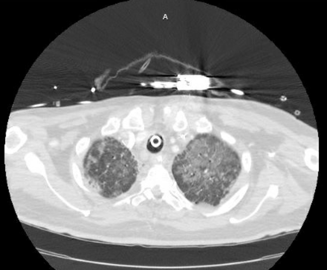 Acute cor pulmonale (ultrasound) (Radiopaedia 83508-98818 Axial lung window 14).jpg