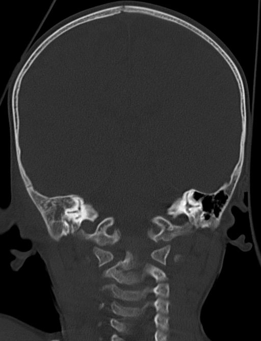 Acute mastoiditis (Radiopaedia 82678-96881 Coronal bone window 48).jpg