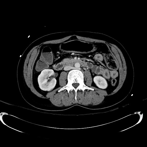 Acute myocardial infarction in CT (Radiopaedia 39947-42415 Axial C+ portal venous phase 61).jpg