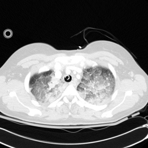 File:Acute myocardial infarction in CT (Radiopaedia 39947-42415 Axial lung window 23).jpg