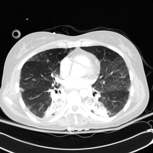 Acute myocardial infarction in CT (Radiopaedia 39947-42415 Axial lung window 72).jpg