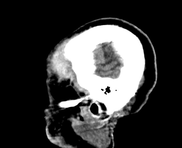 Acute on chronic subdural hematoma (Radiopaedia 78346-90966 Sagittal non-contrast 10).jpg