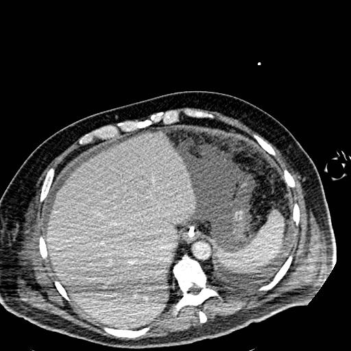 Acute pancreatic necrosis (Radiopaedia 13560-18501 Axial C+ portal venous phase 17).jpg