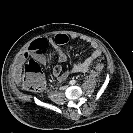 File:Acute pancreatic necrosis (Radiopaedia 13560-18501 Axial C+ portal venous phase 94).jpg