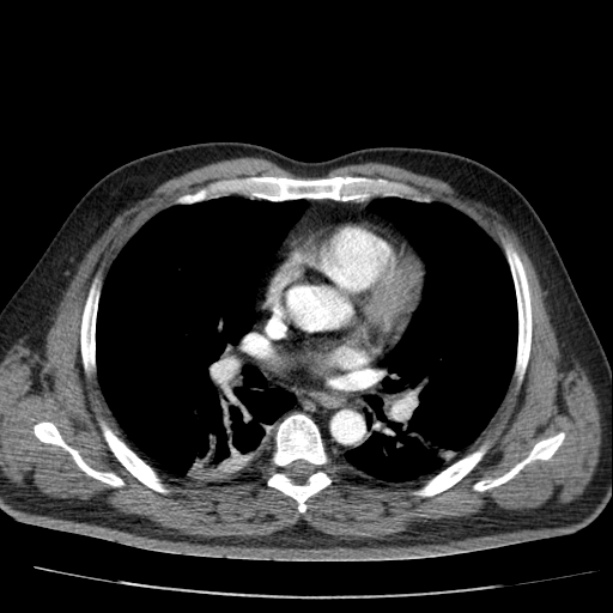 Acute pancreatitis (Radiopaedia 26663-26813 Axial C+ arterial phase 3).jpg