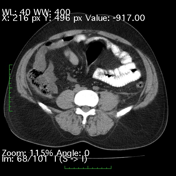 Acute pancreatitis (Radiopaedia 34043-35276 Axial non-contrast 68).jpg