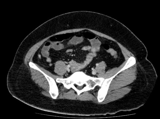 Acute pancreatitis (Radiopaedia 69236-79012 Axial C+ portal venous phase 68).jpg