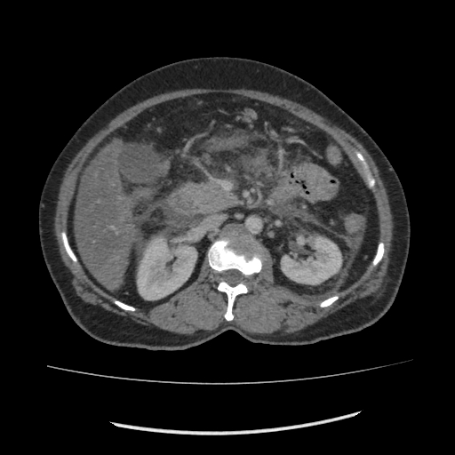 Acute pancreatitis (Radiopaedia 80007-93285 Axial C+ portal venous phase 71).jpg
