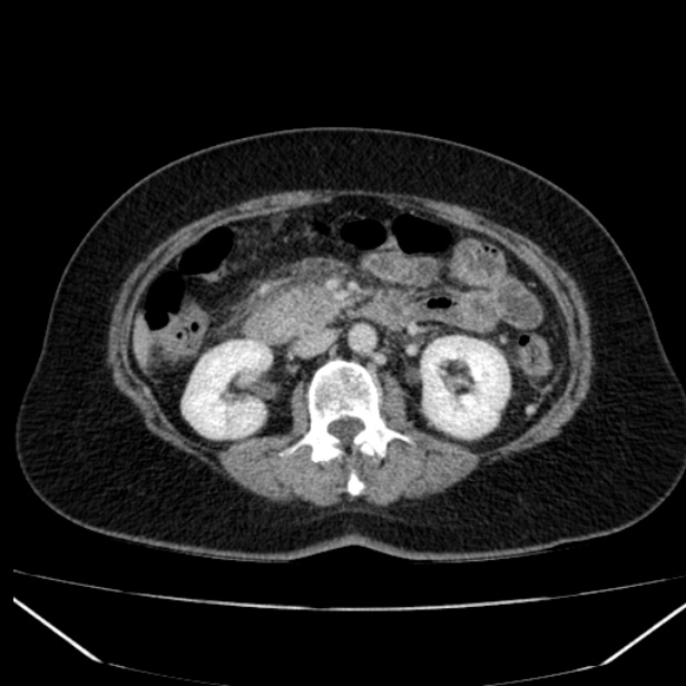 Acute pancreatitis - Balthazar C (Radiopaedia 26569-26714 Axial C+ portal venous phase 46).jpg