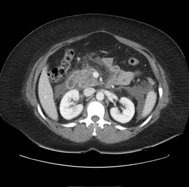 File:Acute pancreatitis - Balthazar E (Radiopaedia 29016-29377 Axial C+ portal venous phase 27).png