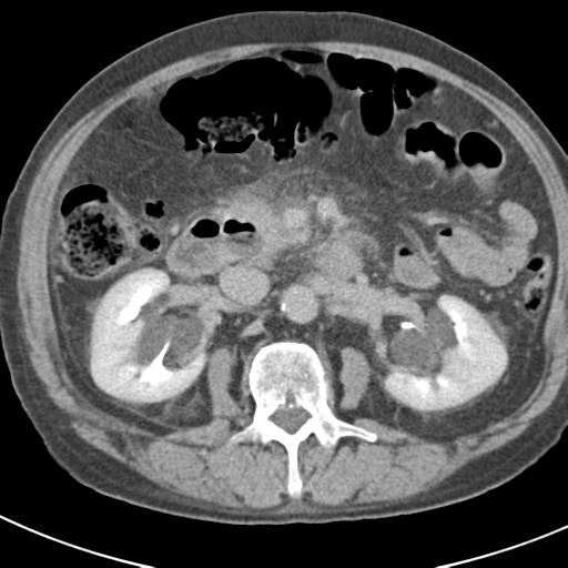 File:Acute pancreatitis and walled-off necrosis (Radiopaedia 29888-30403 Axial C+ delayed 37).jpg