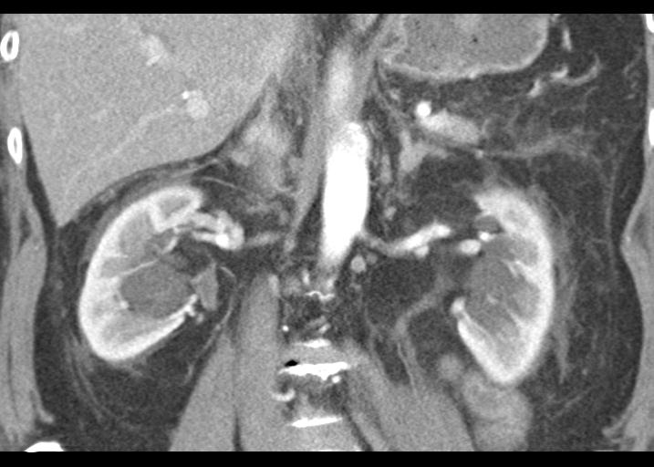 File:Acute pancreatitis and walled-off necrosis (Radiopaedia 29888-30403 Coronal C+ portal venous phase 34).jpg