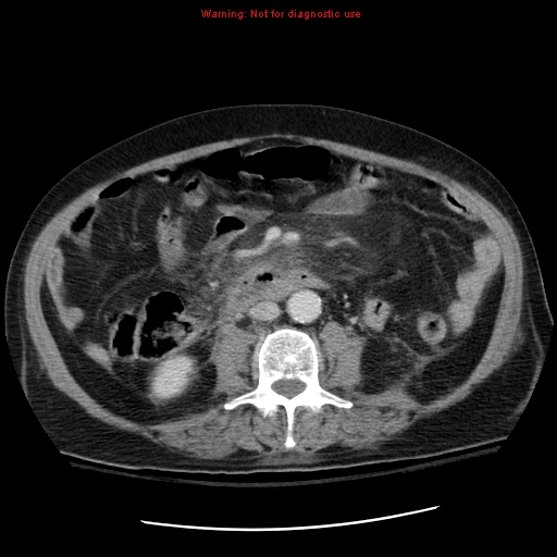File:Acute pancreatitis with incidental pancreatic lipoma (Radiopaedia 10190-10730 Axial C+ portal venous phase 39).jpg
