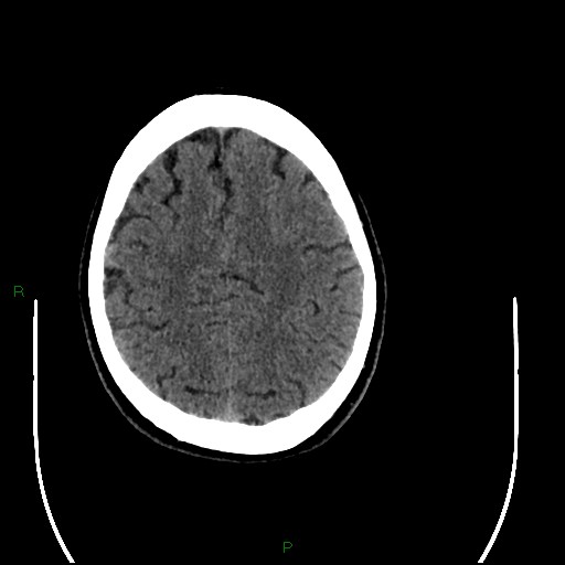 Acute posterior cerebral artery territory infarct (Radiopaedia 79329-92393 Axial non-contrast 84).jpg