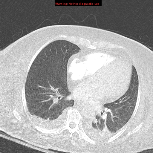 File:Acute pulmonary embolism (Radiopaedia 13286-13289 B 25).jpg