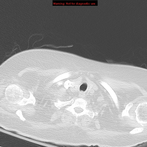 File:Acute pulmonary embolism (Radiopaedia 13286-13289 B 3).jpg