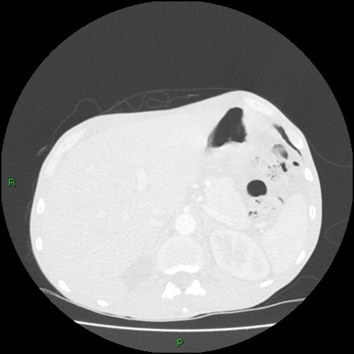 File:Acute right lung abscess (Radiopaedia 34806-36258 Axial lung window 186).jpg