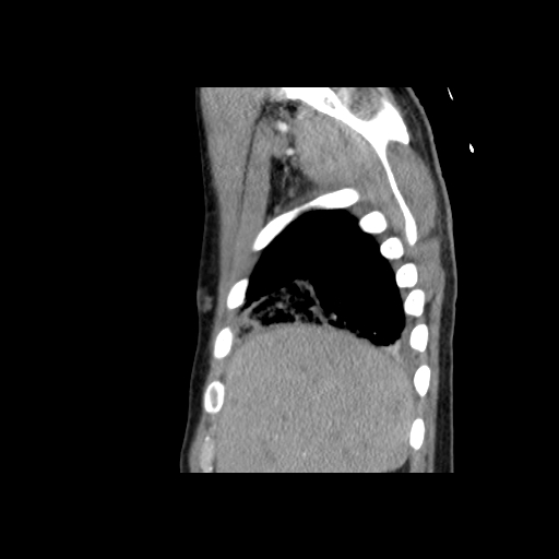 File:Acute segmental pulmonary emboli and pulmonary infarction (Radiopaedia 62264-70444 Sagittal C+ CTPA 12).jpg