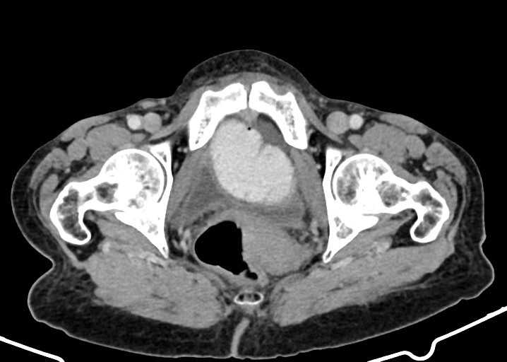 Acute small bowel (ileal) volvulus (Radiopaedia 71740-82139 Axial C+ portal venous phase 189).jpg