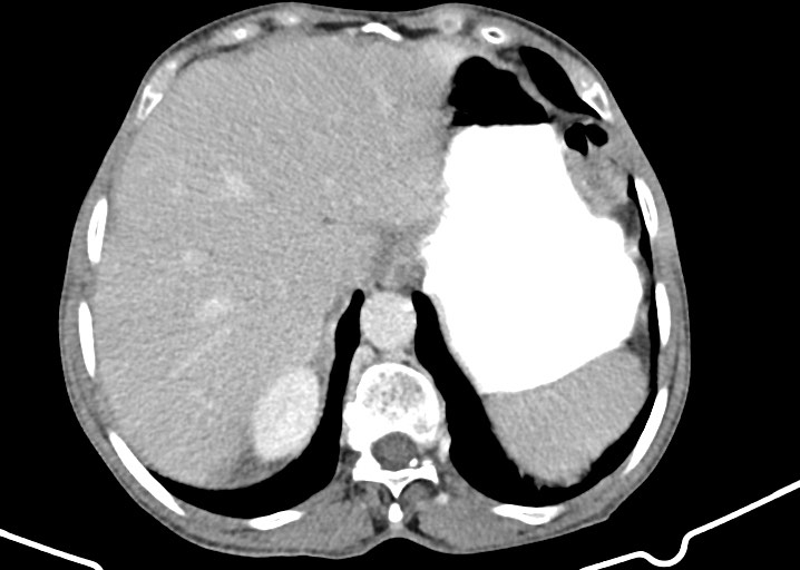 Acute small bowel (ileal) volvulus (Radiopaedia 71740-82139 Axial C+ portal venous phase 53).jpg