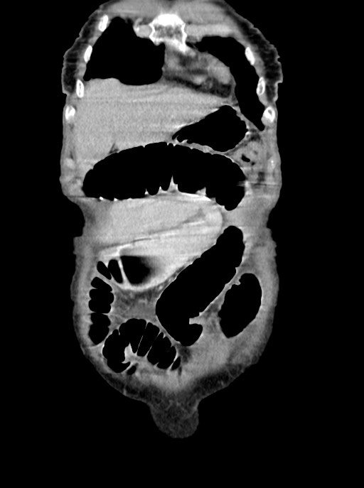 Acute small bowel (ileal) volvulus (Radiopaedia 71740-82139 Coronal C+ portal venous phase 19).jpg