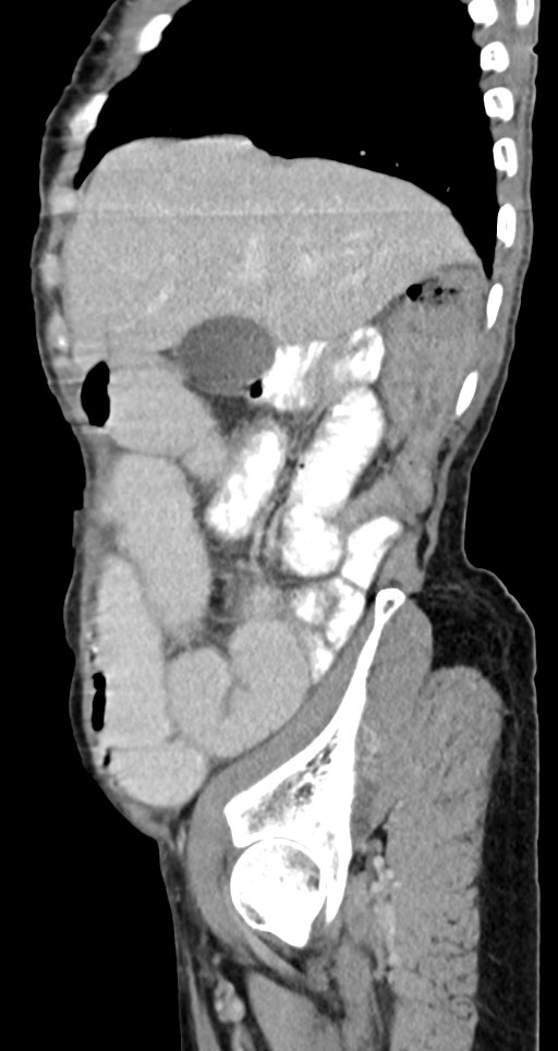 Acute small bowel (ileal) volvulus (Radiopaedia 71740-82139 Sagittal C+ portal venous phase 125).jpg