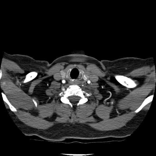 Acute subarachnoid hemorrhage and accessory anterior cerebral artery (Radiopaedia 69231-79009 Axial C+ arterial phase 36).jpg