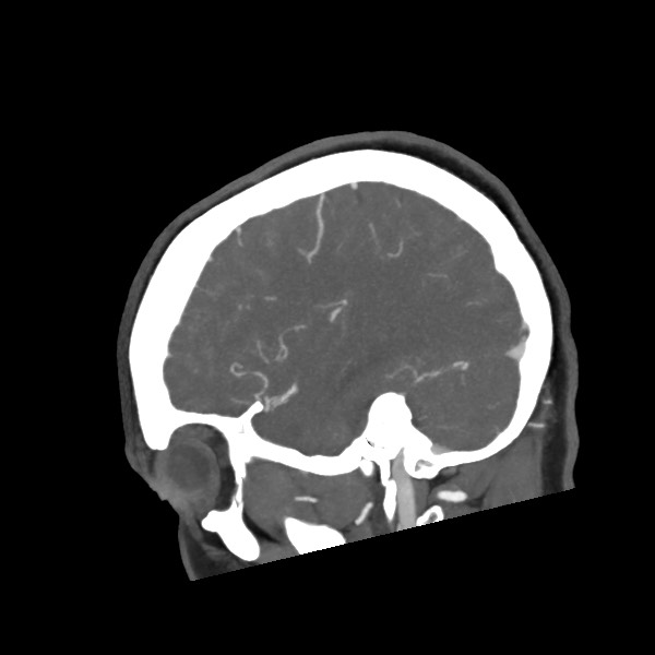 Acute subarachnoid hemorrhage and accessory anterior cerebral artery (Radiopaedia 69231-79009 Sagittal C+ arterial phase 21).jpg