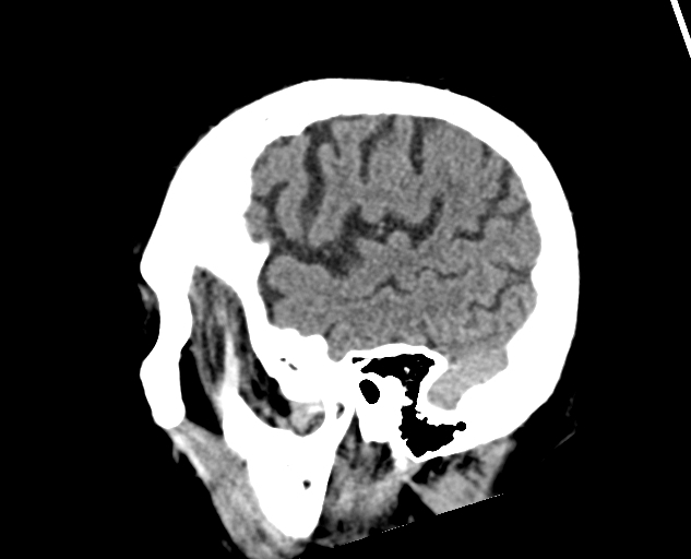 Acute traumatic subdural hematoma (Radiopaedia 82921-97257 Sagittal non-contrast 58).jpg