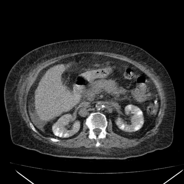 Acute tubular necrosis (Radiopaedia 28077-28334 Axial non-contrast 28).jpg