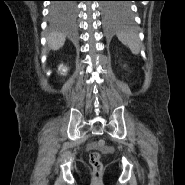 Acute tubular necrosis (Radiopaedia 28077-28334 G 66).jpg