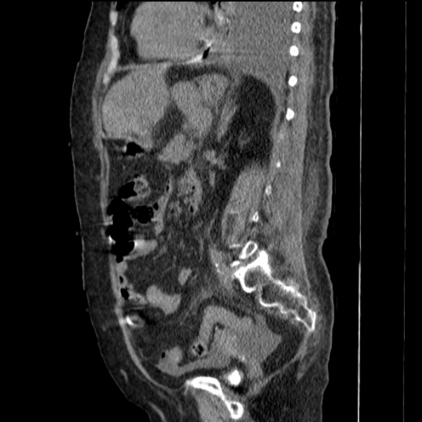Acute tubular necrosis (Radiopaedia 28077-28334 Sagittal non-contrast 55).jpg