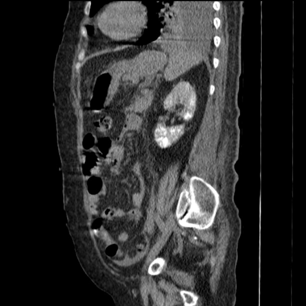 Acute tubular necrosis (Radiopaedia 28077-28334 Sagittal non-contrast 60).jpg