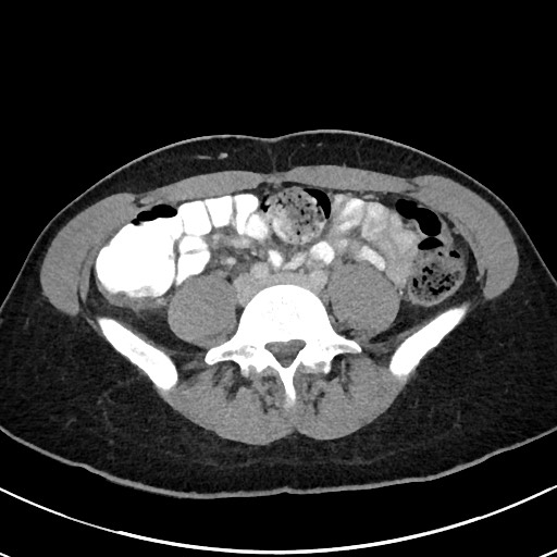 Acute uncomplicated appendicitis (Radiopaedia 61374-69304 Axial C+ portal venous phase 75).jpg