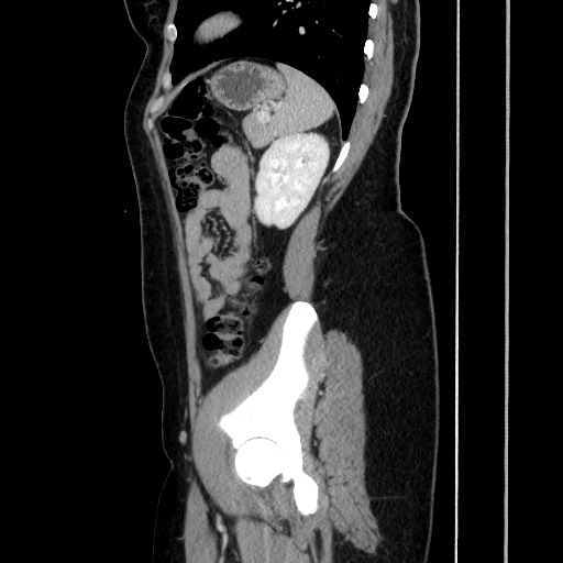 Acute uncomplicated appendicitis (Radiopaedia 73704-84499 Sagittal C+ portal venous phase 150).jpg