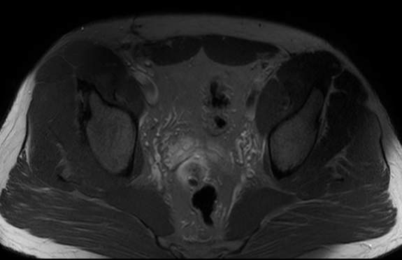 File:Adductor longus tear with retraction (Radiopaedia 56424-63103 Axial T2 fat sat 6).jpg
