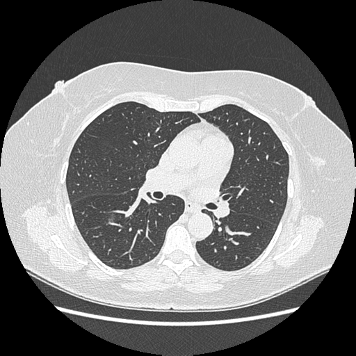 Adenocarcinoma in situ of lung (Radiopaedia 38685-40829 B 109).png