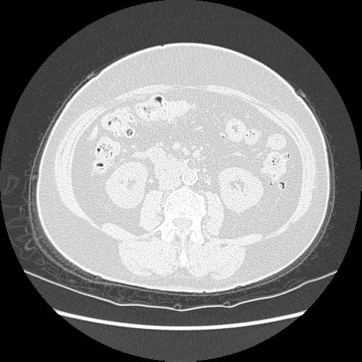 Adenocarcinoma in situ of lung (Radiopaedia 38685-40829 B 281).png