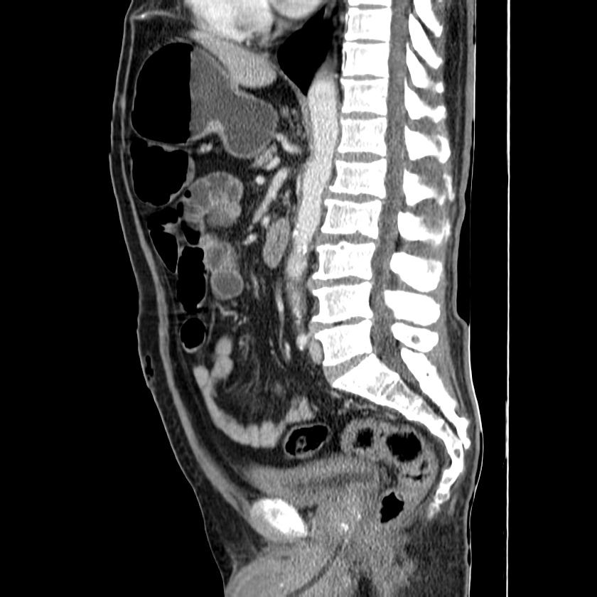 Adenocarcinoma of colon with entero-colic fistula (Radiopaedia 22832-22852 Sagittal C+ portal venous phase 34).jpg