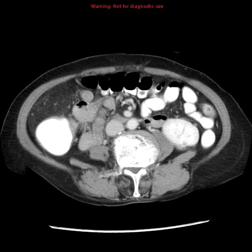 Adenocarcinoma of the colon (Radiopaedia 8191-9039 Axial liver window 40).jpg