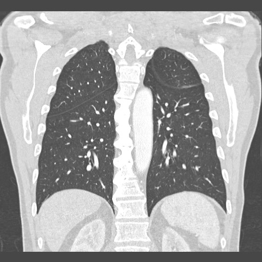 Adenocarcinoma of the lung (Radiopaedia 59871-67325 Coronal lung window 45).jpg