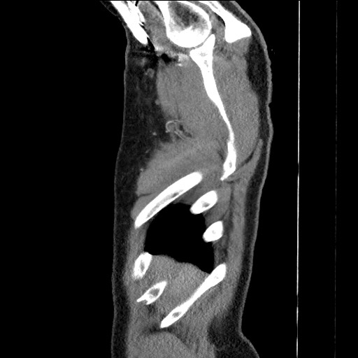 File:Adenocarcinoma of the lung (Radiopaedia 59871-67325 Sagittal C+ arterial phase 2).jpg