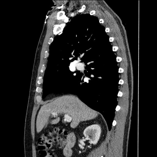Adenocarcinoma of the lung (Radiopaedia 59871-67325 Sagittal C+ arterial phase 36).jpg